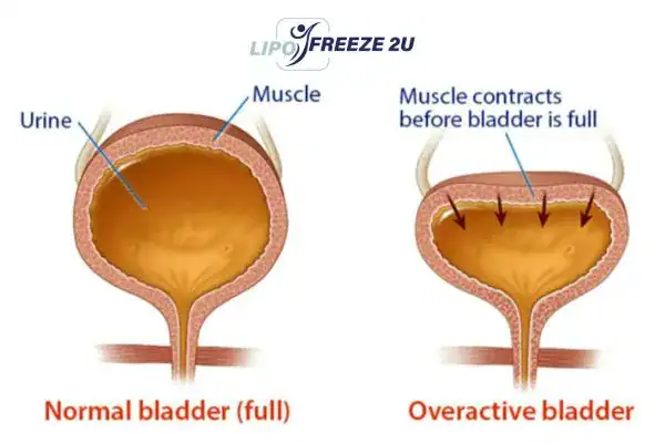 diagram of overactive bladder treatment Braintree