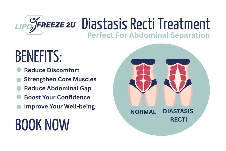 How Long Will It Take to See Improvements in Diastasis Recti Braintree