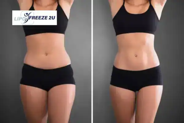 How Can LIPO FREEZE 2U Support Your Post-Pregnancy Body Recovery Braintree?