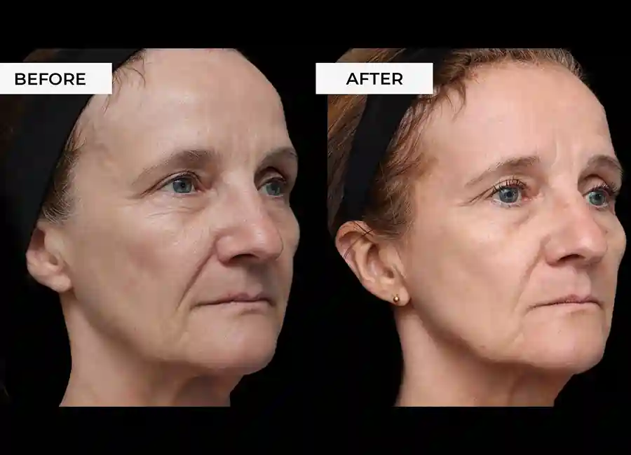 How Many RF Microneedling Sessions Will You Need to See a Difference Braintree?