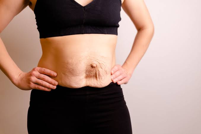 Is Surgery Really the Only Way to Repair Diastasis Recti Braintree?