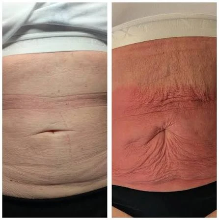 How Does RF Microneedling Improve Crepey, Thin and Uneven Skin Texture Braintree?