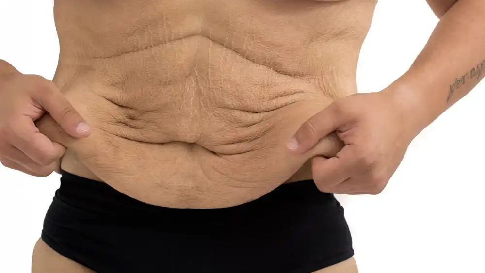 Why Does Weight Loss Medication Leave Some People With Loose or Sagging Skin Braintree?